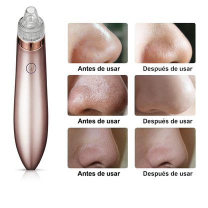 Removedor eléctrico de puntos negros, aspirador de poros con succión y limpiador facial con dermoabrasión con punta de diamante.