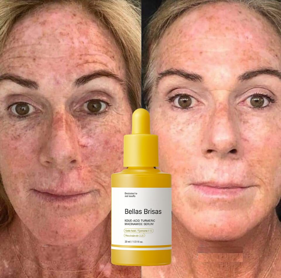 Kojic Acid Turmeric