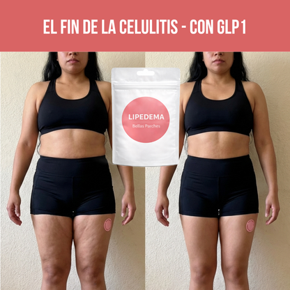 Lipedema (Bellas Parches)